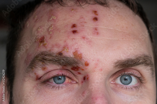 Man with Herpes Zoster (shingles) on the face, close up. Inflamed eyelid and red eye of a man suffering from herpes on the face. Purulent blisters on the face during Shingles photo