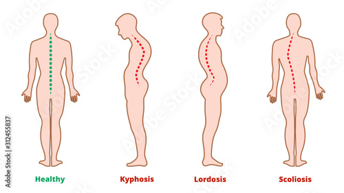Diseases of the spine. Scoliosis, lordosis, kyphosis. Body posture defects. Back curvature. Spinal deformity types. Medical disease infographic. Diagnostic symptom. Vector illustration. photo
