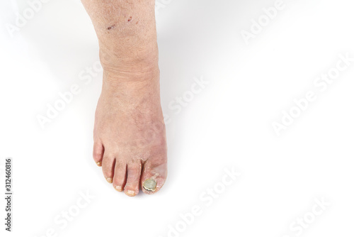 Toenail fungus isolated on white. Sore toenail, nail fungus close up photo