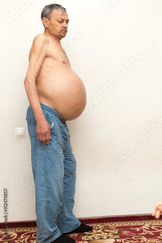 ascitic disease in man