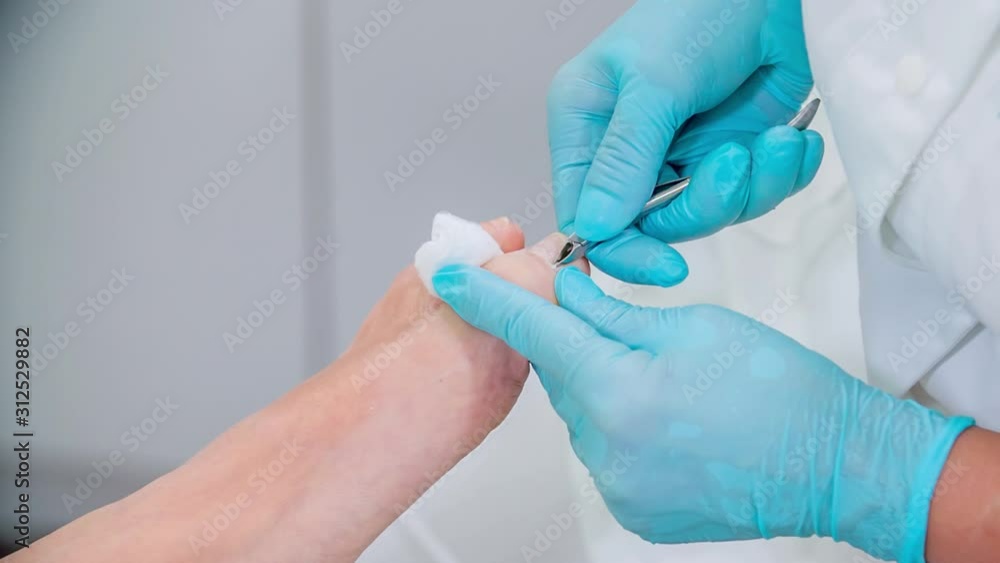 Masseur is using nail clippers to cut the client's nails on her feet. She is also doing a pedicure and a massage of her feet and is using blue protection gloves. Masseur is using nail clippers to cut the client's nails on her feet. She is also doing a pedicure and a massage of her feet and is using blue protection gloves.