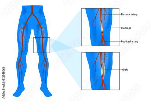 Femoral popliteal (also called femoropopliteal or Fem-Pop) bypass surgery. Graft bypass.   photo