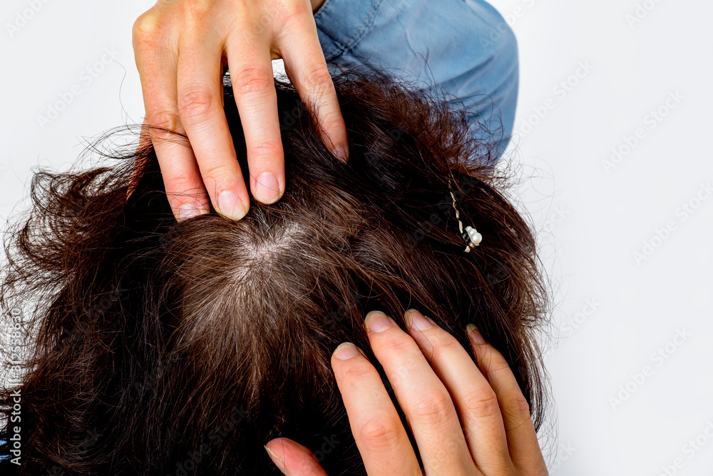 Fototapeta premium Woman controls head on hair loss