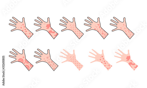 Skin rash, insect bites allergy reaction. irritation on hand. vector illustration