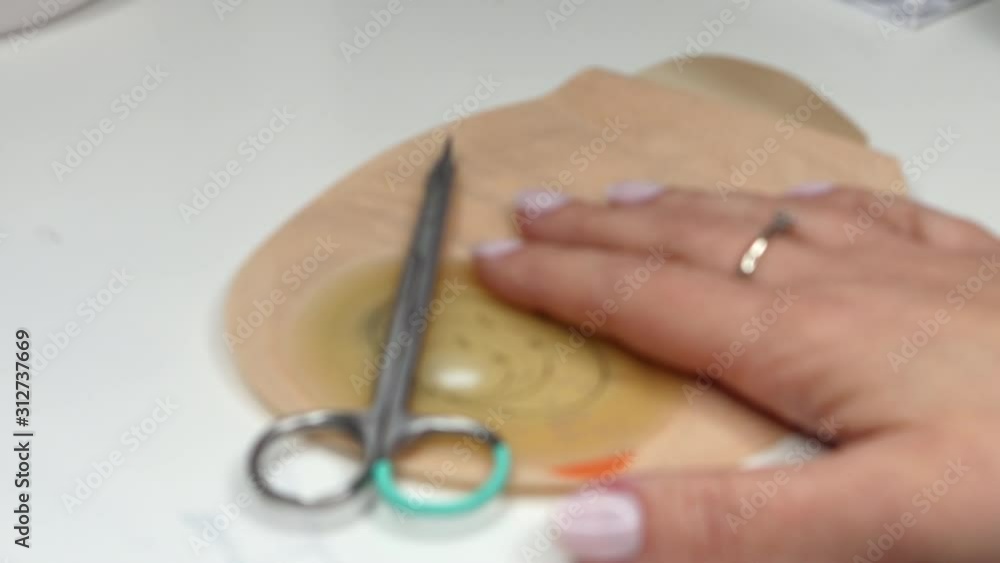 Zoom in colostomy bag, supply needed after colostomy surgery - colon cancer treatment. Ostomy bag with filter in skin color. Medical theme. Preparing stoma bag for use Zoom in colostomy bag, supply needed after colostomy surgery - colon cancer treatment. Ostomy bag with filter in skin color. Medical theme. Preparing stoma bag for use