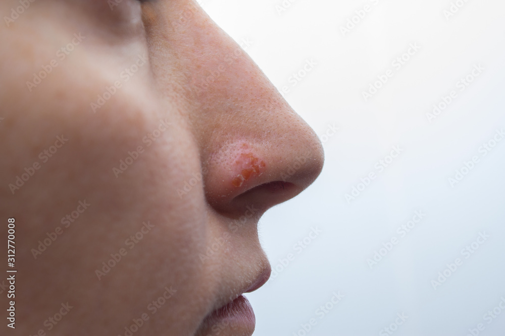 Herpes on the nose - Pretty young caucasian woman with herpes her on nose, close-up. Human Virus Herpes on the nose - Pretty young caucasian woman with herpes her on nose, close-up. Human Virus