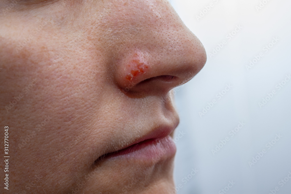 Herpes on the nose - Pretty young caucasian woman with herpes her on nose, close-up. Human Virus Herpes on the nose - Pretty young caucasian woman with herpes her on nose, close-up. Human Virus