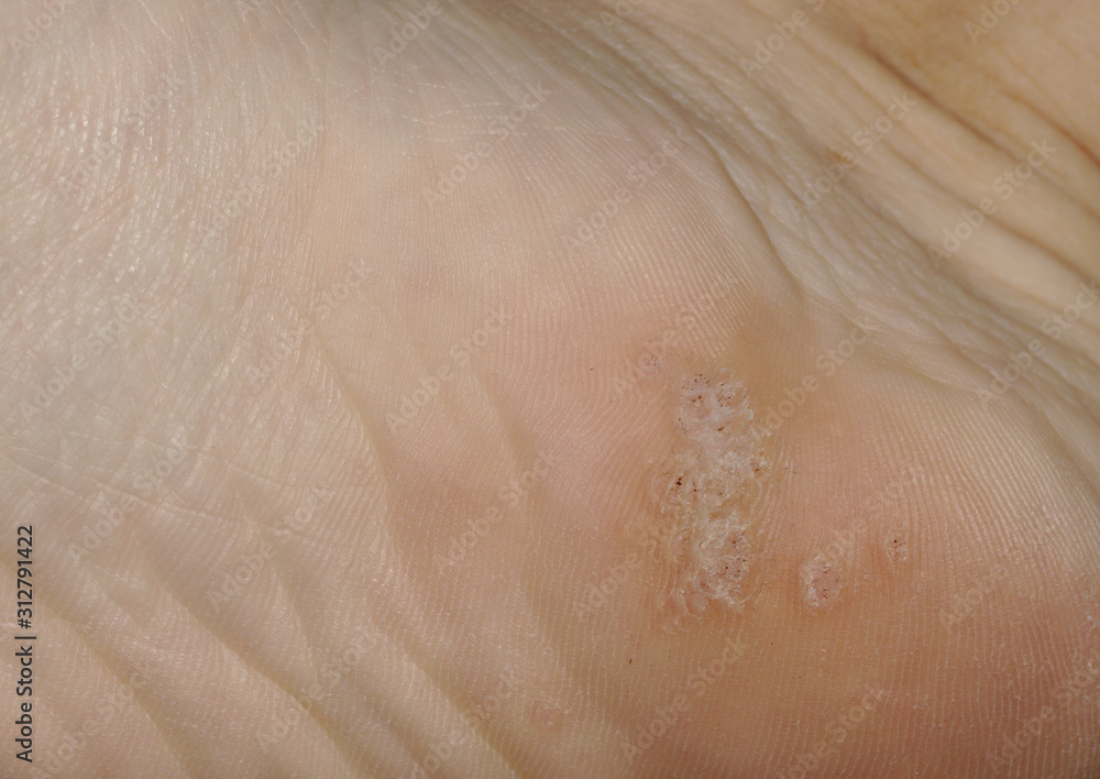 Closeup shot of a plantar wart on the bottom of a foot heel caused by
