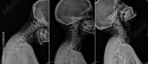 Cervical x-ray photo