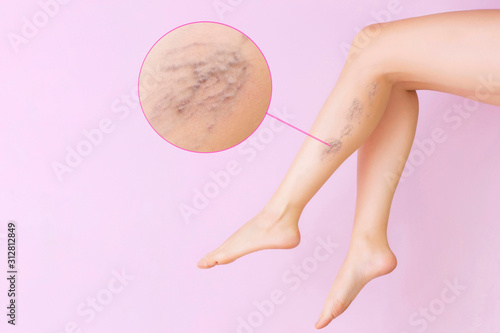 Female legs with varicose veins. Concept of human health and disease. Vascular diseases, problems of varicose veins. Enlarged image of blood vessels