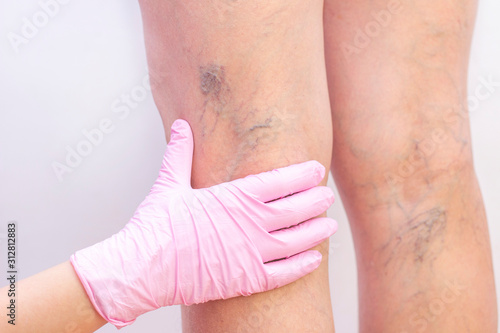 Female legs with varicose veins. At the doctors surgeons appointment. doctors hands in gloves. Concept of human health and disease. Vascular diseases, problems of varicose veins