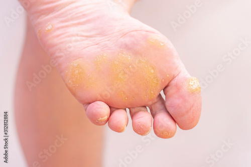Warts and corns on a womans foot. dermatology disease. plantar warts. at the appointment with a dermatologist. female foot with warts on a light background.