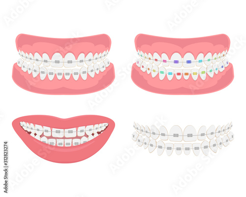 Dental jaw with braces, correct bite of dentition.