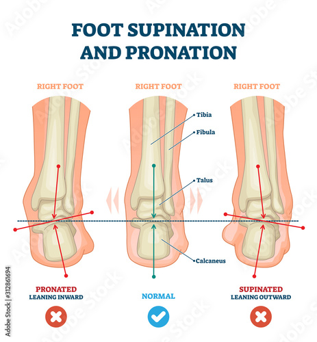 Foot supination and pronation vector illustration. Labeled medical scheme.