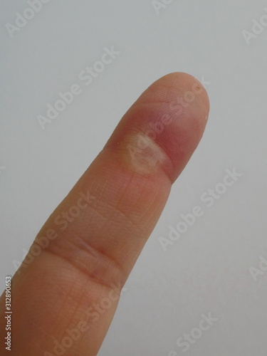 Finger with burn on the skin from injured