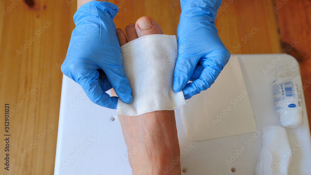 Fototapeta premium Nurse is putting antiseptic dressing at the wounded foot