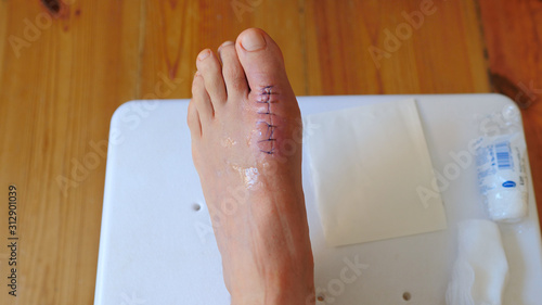 Принти на полотні Postoperative sutures on the foot.
