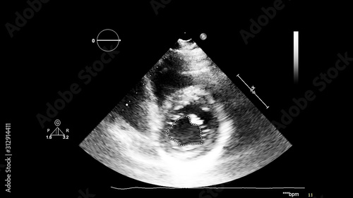 Image of the heart in gray-scale mode during transesophageal ultrasound.