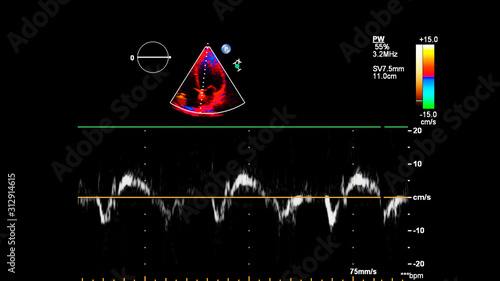 Image of the heart during transesophageal ultrasound with Doppler mode.