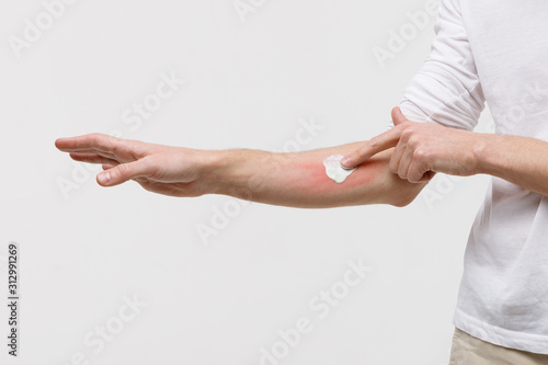 Bouts of allergies concept. Allergic reaction, itch, dermatitis, dry skin. Man is applying cream/ointment on the swell skin against mosquito bites, isolated on white background, close up.  photo