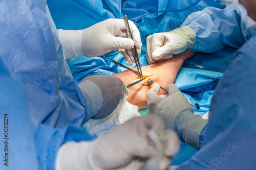 Group of surgeons performing an elbow surgery
