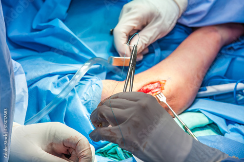 Group of surgeons performing an elbow surgery