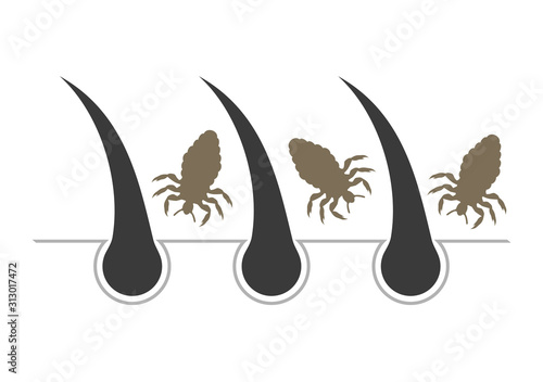 louses in hair illustration