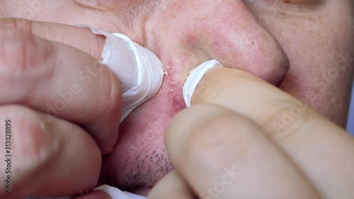Man squeezing pimples on face. Long-term skin disease near nose. Beauty, skin care lifestyle concept. Cheek with typical problem with acne in adulthood time