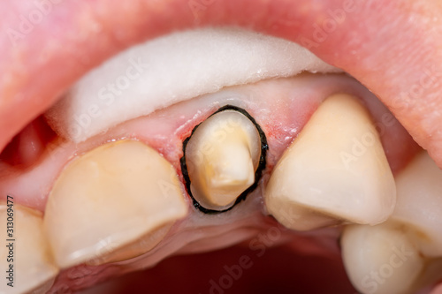 preparation of a human tooth for the manufacture of crowns, dental impression. Close-up macro