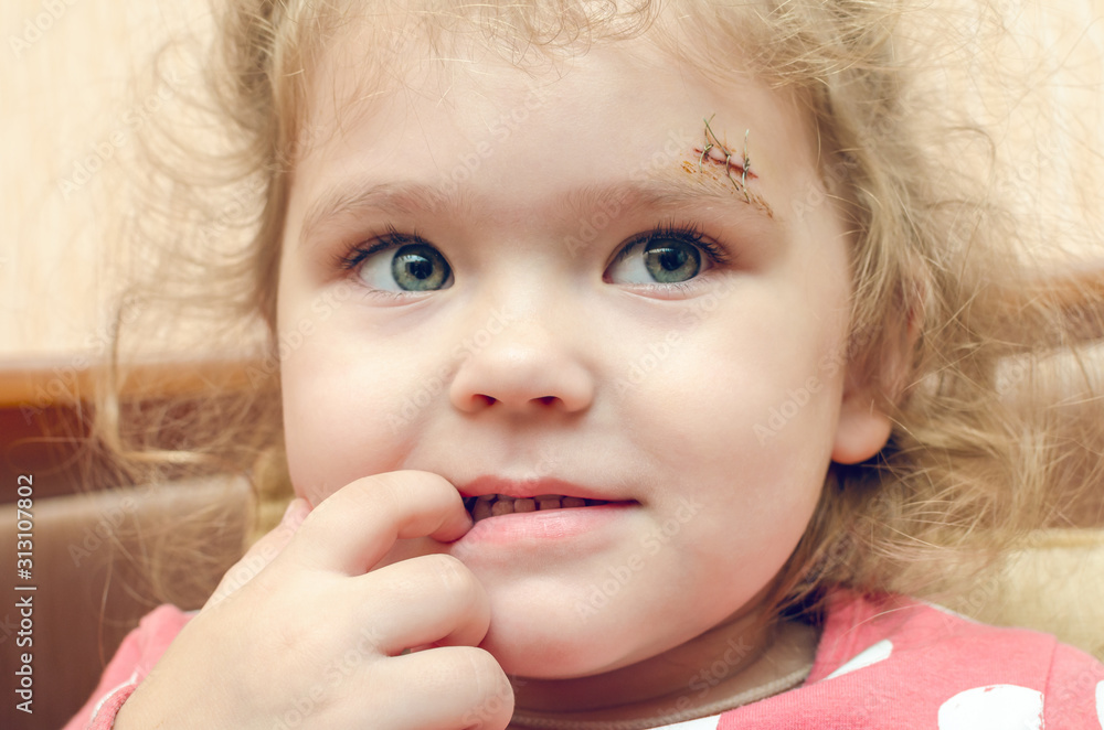 A little girl with a scar above her eyebrow, a deep wound sewn up A little girl with a scar above her eyebrow, a deep wound sewn up