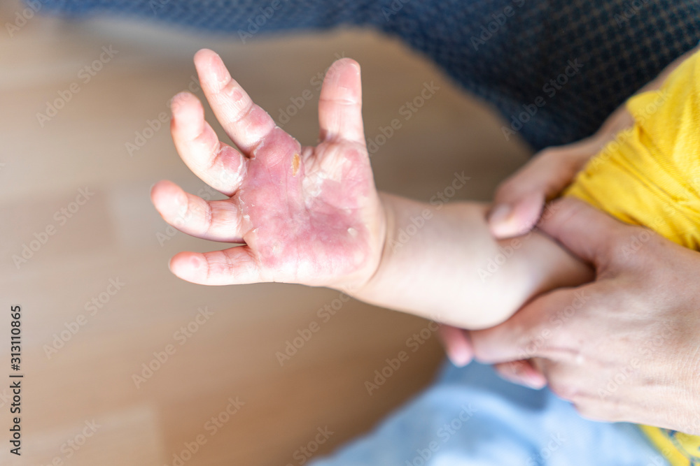 Burned hand of small child Burned hand of small child
