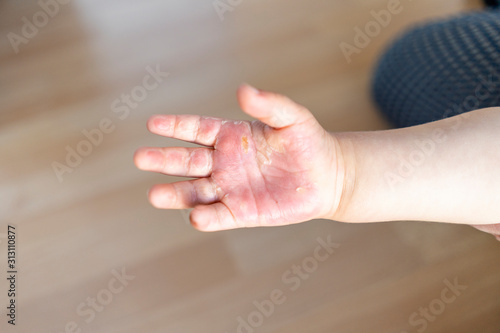 Burned hand of small child