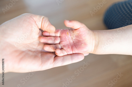Obraz na płótnie Burned hand of small child w salonie