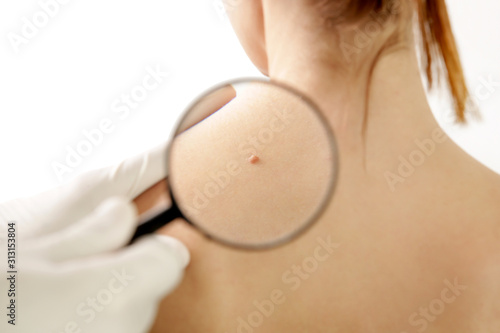 Dermatologist checking mole through magnifying glass