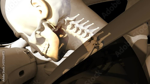 Whiplash In Car Accident