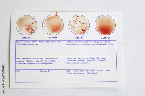 Home blood type testing for type A+