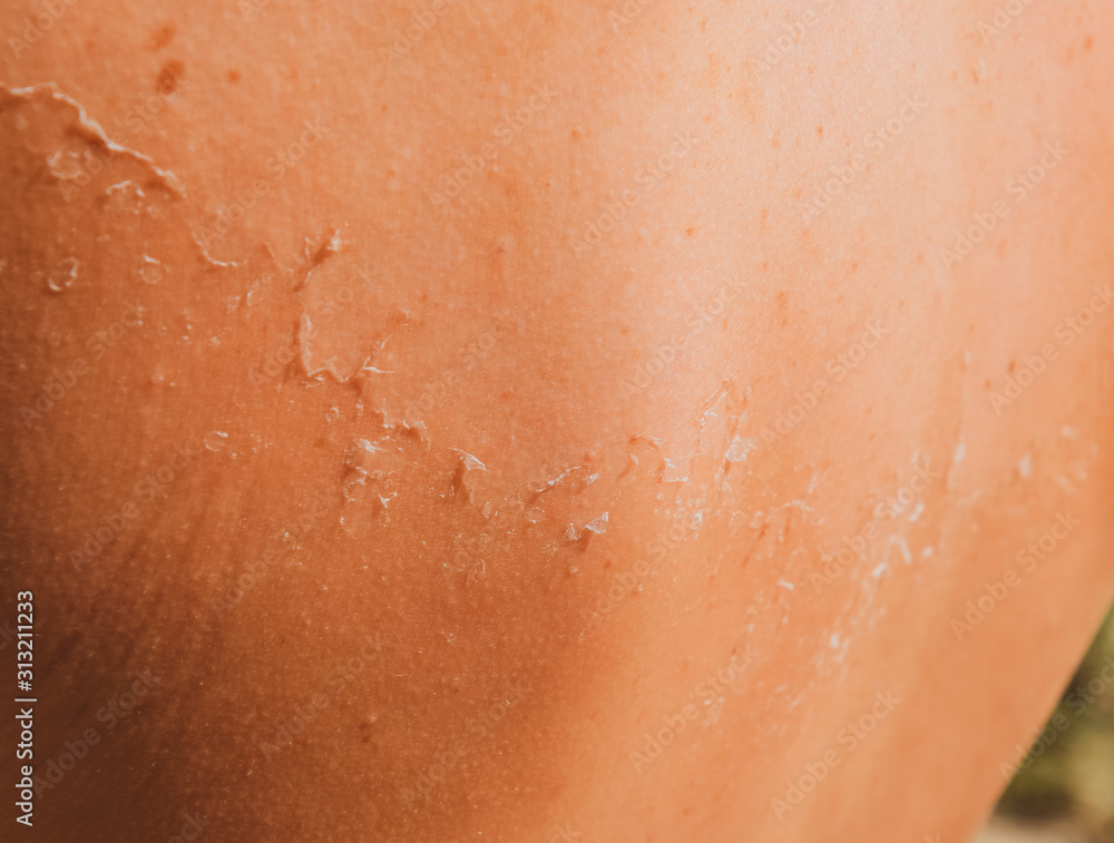 Fototapeta premium Sunburn on the skin of the back. Exfoliation, skin peels off. Dangerous sun tan