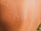 Sunburn on the skin of the back. Exfoliation, skin peels off. Dangerous sun tan
