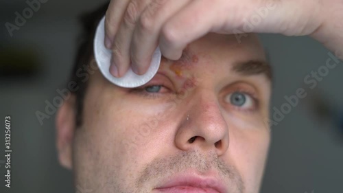 man with herpes zoster, Shingles, on his face treats purulent blisters photo