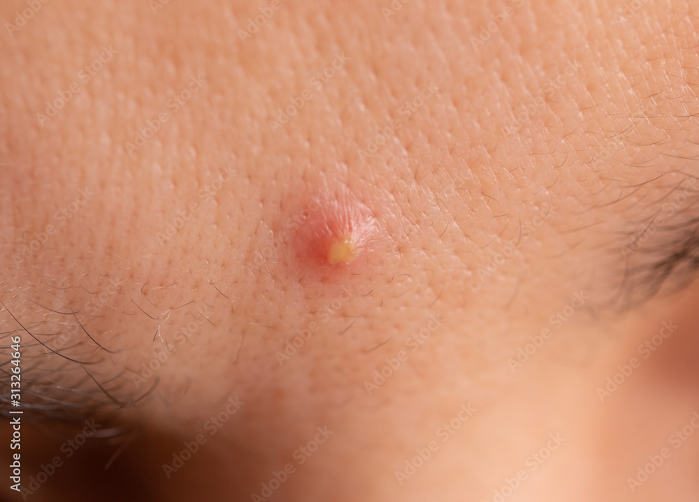 inflamed acne on the skin of the face