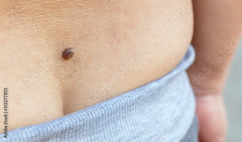 Hairy skin mole or melanoma of the skin of the back on a man's body. Proliferation of pigment dermal cells. Dermatologist medical laser skin melanoma removal concept.