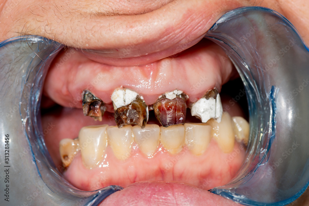 Obraz premium Plaque of the patient, stone. Dentistry treatment of dental plaque, professional oral hygiene. The concept of harm to smoking and cleaning teeth