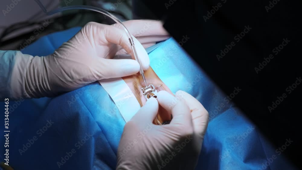 Laser vision correction. A patient and team of surgeons in the operating room during ophthalmic