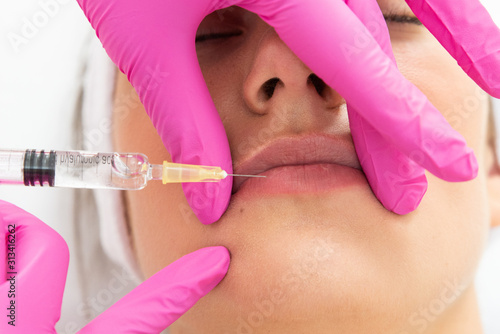 Powiększenie ust kwasem hialuronowym. Zbliżenie na usta kobiety podczas zabiegu modelowania ust. Kosmetolog wstrzykuje wypełniacz, medycyna estetyczna. 