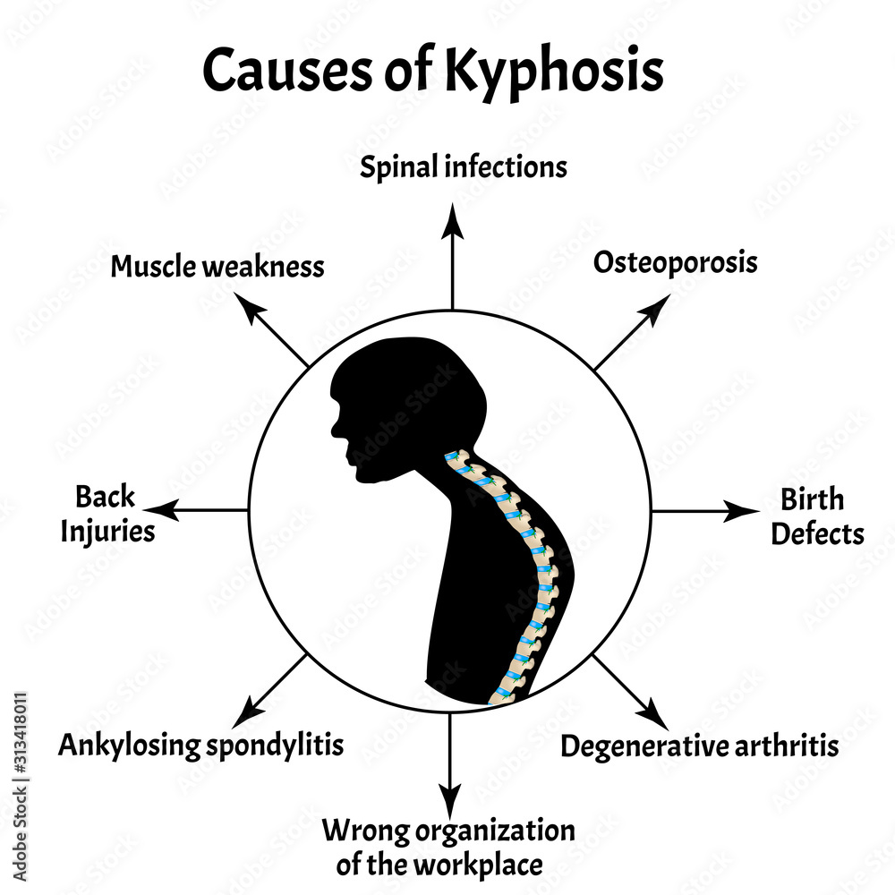 Causes of kyphosis. Spinal curvature, kyphosis, lordosis, scoliosis