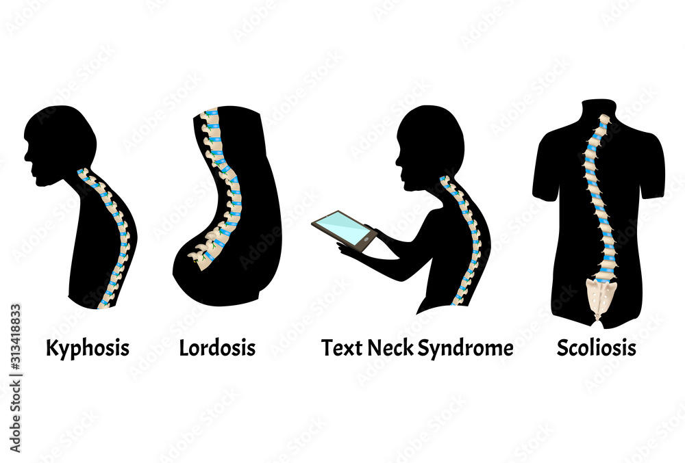The position of the spine with lordosis, kyphosis. Text Neck Syndrome