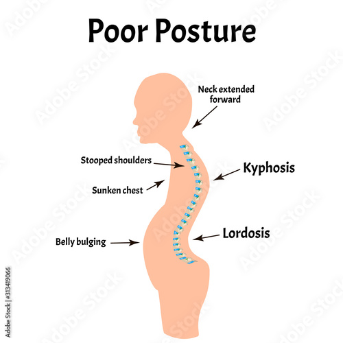 Improper posture symptoms. Text Neck Syndrome. Spinal curvature, kyphosis, lordosis, scoliosis, arthrosis. Improper posture and stoop. Infographics. Vector illustration on isolated background.