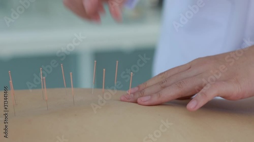 hand of doctor performing acupuncture therapy . Asian female undergoing acupuncture treatment with a line of fine needles inserted into the her body skin in clinic hospital