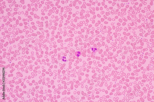 Human blood smear view in microscopy.Complete blood count for treatment. Polymorphonuclear cells(PMNs), eosinophils and lymphocytes.Hematology laboratory.Medical background.Magnification 600 x. photo