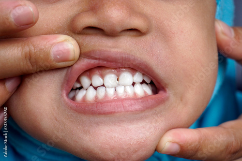 Girl child mouths are opened by fingers with dental cavities for International Dentist Day background